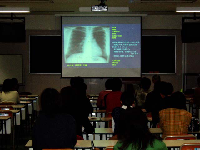 X線写真による肺炎の説明